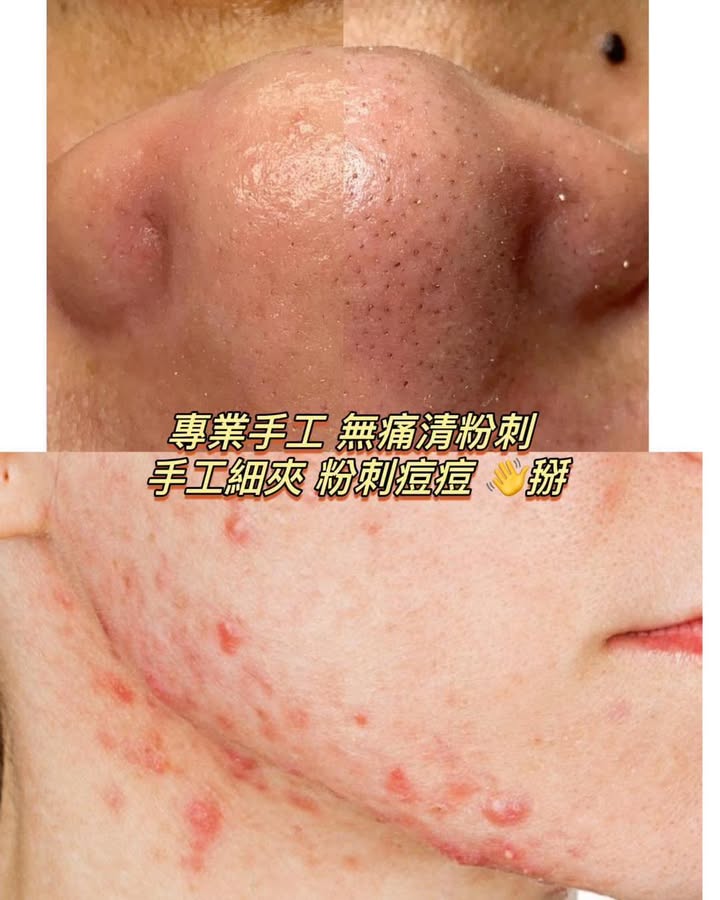 手工無痛清粉刺